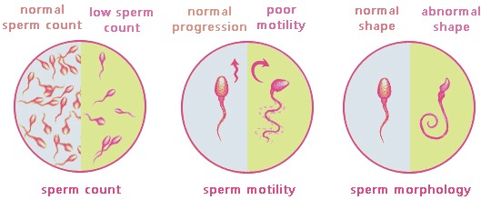 male infertility (sperm abnormality)