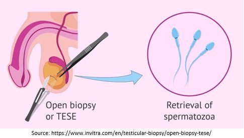 Testicular Sperm Extraction