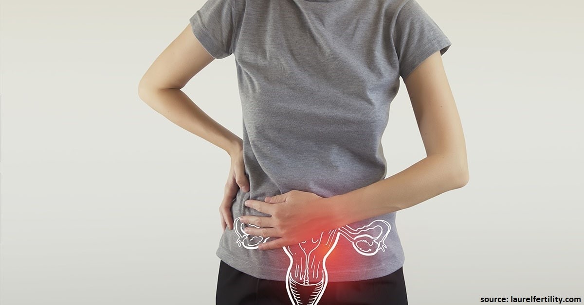 Blocked Fallopian Tubes