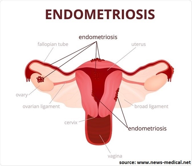 Getting Pregnant With Endometriosis Is It Possible Nisha Ivf Centre