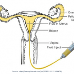 Hysterosalpingogram