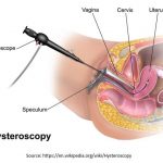 Hysteroscopy