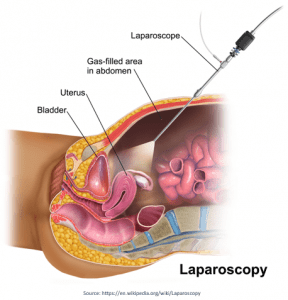 Laparoscopy