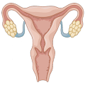 Polycystic ovaries