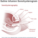 Sonohysterogram - Saline Infusion Sonogram