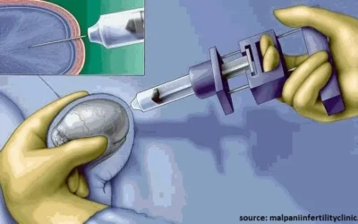 Is Testicular Sperm Aspiration (TESA) Painful?