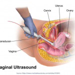 Vaginal Ultrasound