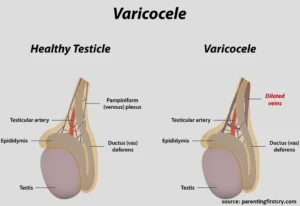 varicoceles-cause-infertility