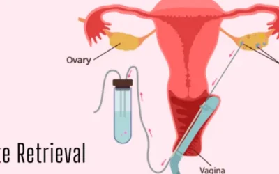 Oocyte Retrieval: What one should know?