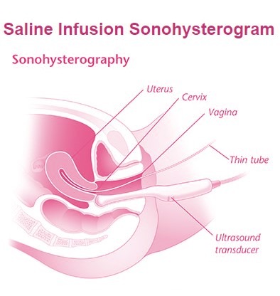 Sonohysterosalpingography