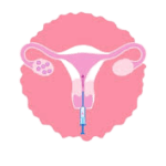 Frozen Embryo Transfer