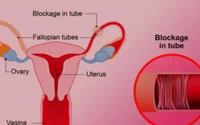 Blockage of the Fallopian Tubes & Female Infertility