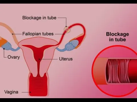 Blockage of the Fallopian Tubes & Female Infertility