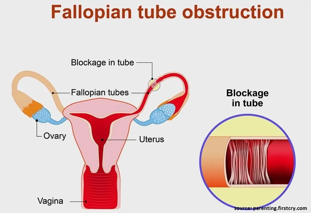 Fallopian-tube-blockage