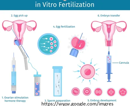 IVF