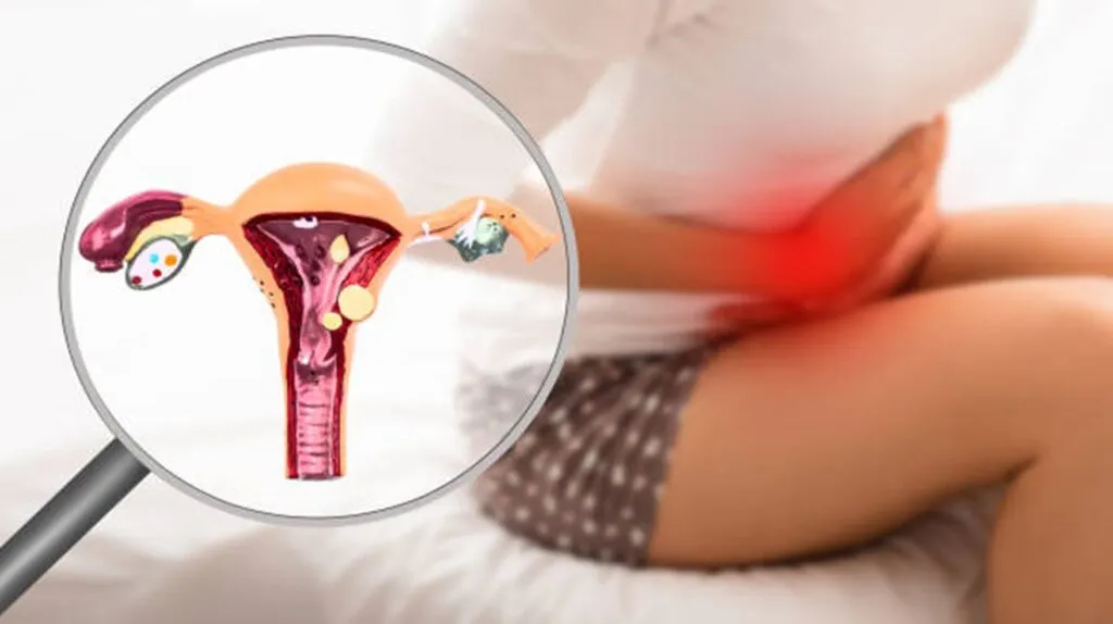 Managing Endometriosis After Ablation