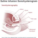 Sonohysterogram-Saline-Infusion-Sonogram