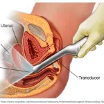 Transvaginal-Ultrasonography