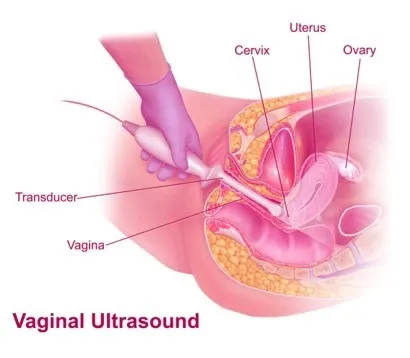 Transvaginal-Ultrasound