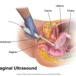 Vaginal-Ultrasound