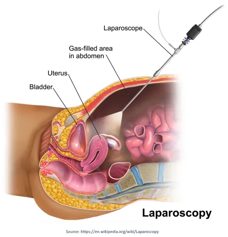 laparoscopic surgery