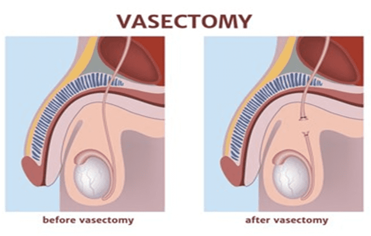 vasectomy