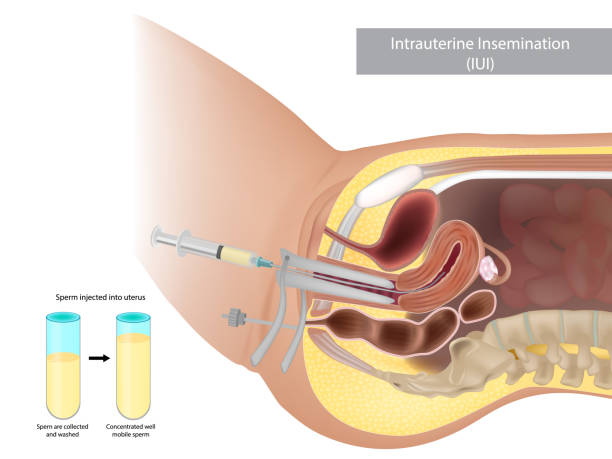 Potential Causes of White Discharge 6 Days After IUI