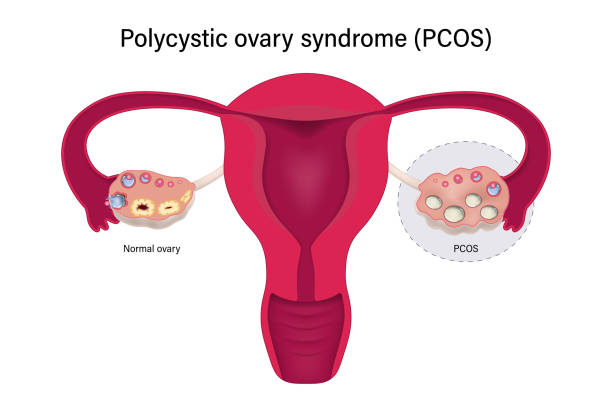 What Can It Mean to Have No Period 22 Days post-IUI?