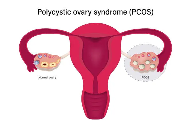 What Can It Mean to Have No Period 22 Days post-IUI? What Can It Mean to Have No Period 22 Days post-IUI?