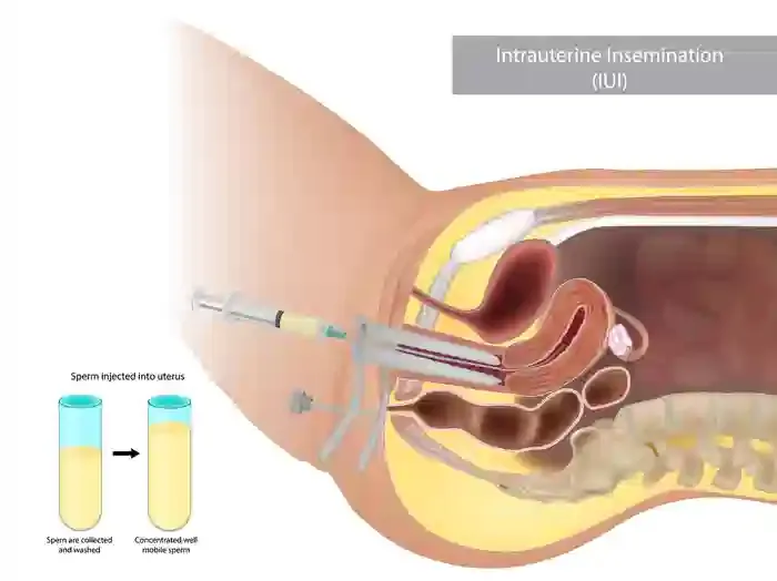 When Does One Experience White Discharge After IUI? When Does It Stop?