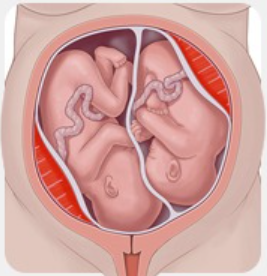 Cross-section of the uterus showing twins in separate amniotic sacs with visible umbilical cords and shared placenta.
