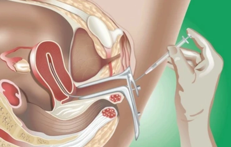 About IUI