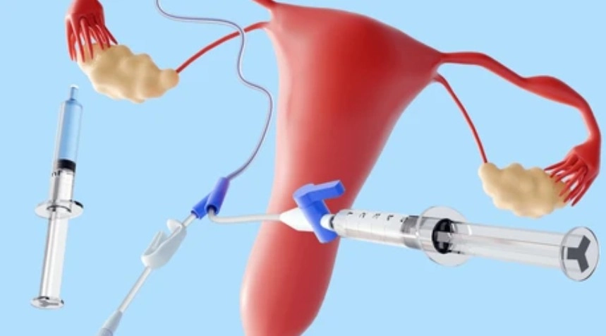IUI