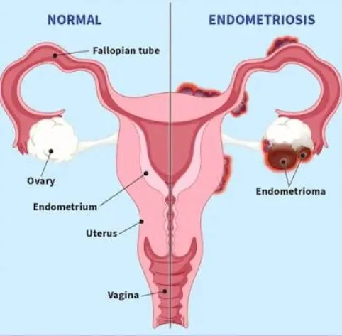 Causes and Risk Factors of Endometriosis