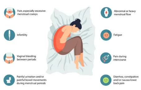 Symptoms of Endometriosis